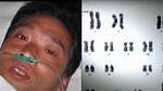 Hisashi Ouchi Real Photos, Suffered 83 Days of Death from Radiation Poisoning
