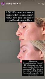 Juliette Porter Plastic Surgery Explained: Nose Job, Teeth Veneer and More