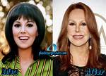Marlo Thomas' Plastic Surgery Journey
