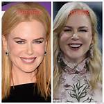 Nicole Kidman's Plastic Surgery Journey: Enhancements, Procedures, and Results