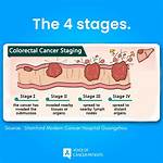 Pioneer Woman Colon Cancer Stage 4: a Comprehensive Guide