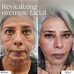 Transformations of the Face: Before and After High Cortisol Levels
