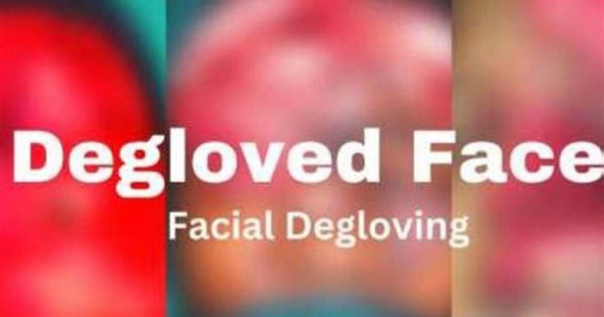 Unveiling the Horrors: Understanding the Degloved Face💀